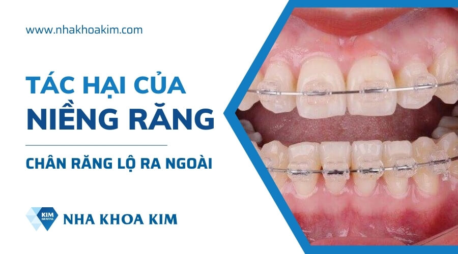 Tác hại của niềng răng sai cách gây lộ chân răng