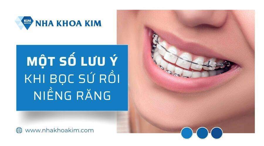 Một số lưu ý khi niềng răng sau bọc sứ