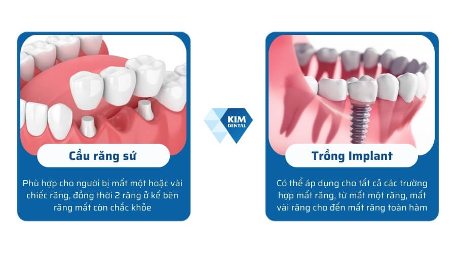 Nên làm cầu răng hay implant?