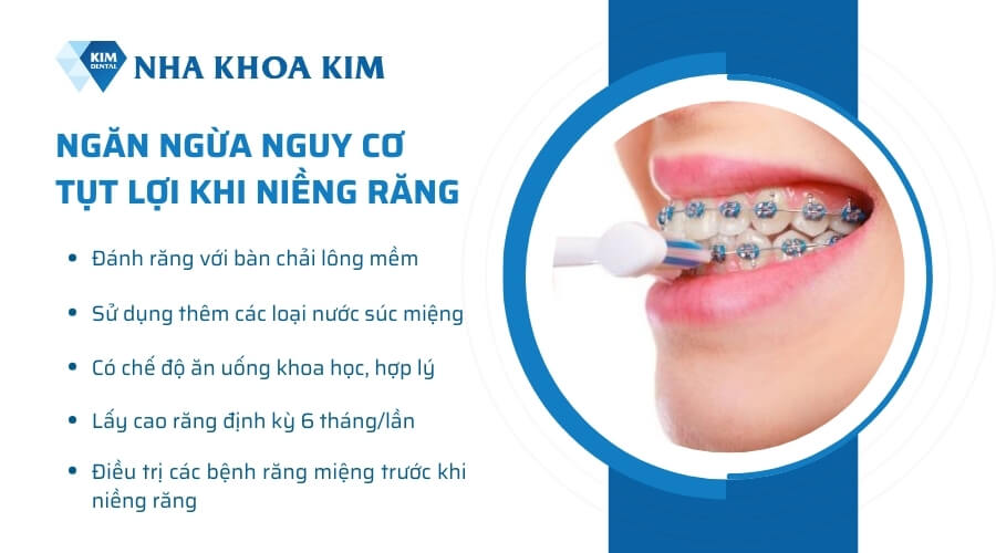 Làm sao để ngăn ngừa nguy cơ tụt lợi khi niềng răng