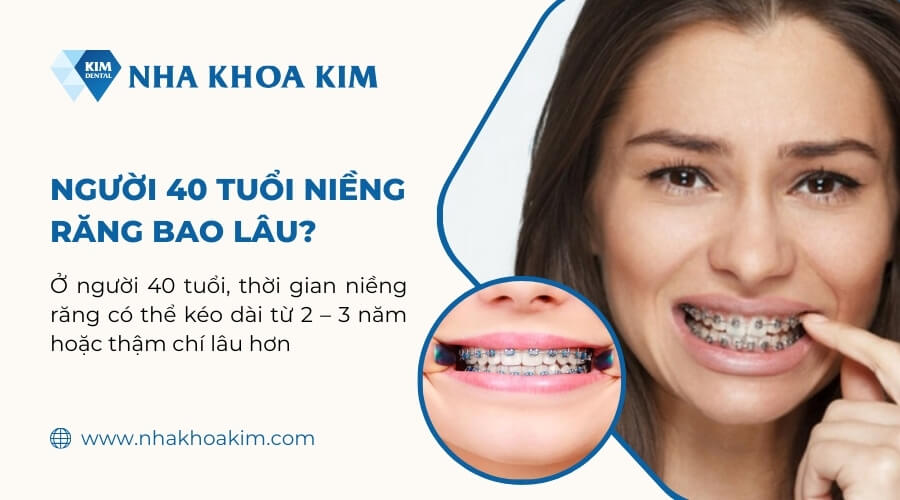 Người 40 tuổi niềng răng mất bao lâu?