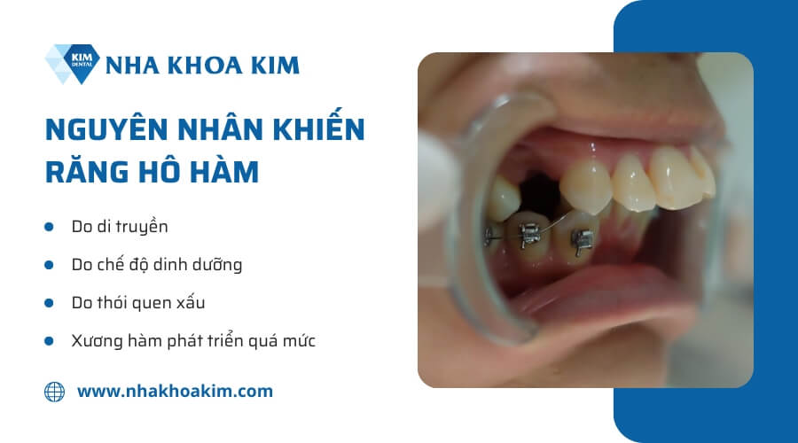 Nguyên nhân khiến răng hô hàm