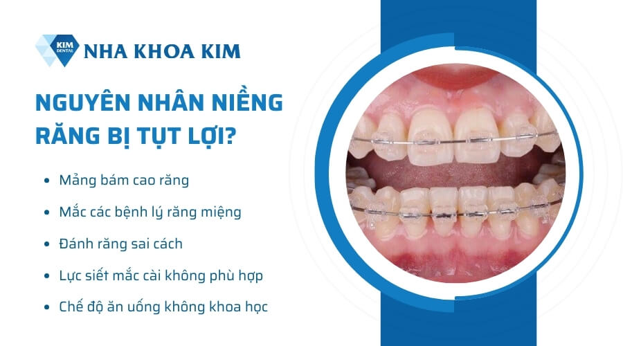 Nguyên nhân khiến niềng răng bị tụt lợi?