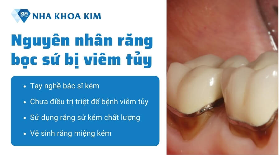 Nguyên nhân răng bọc sứ bị viêm tủy 