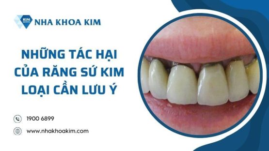 Những tác hại của răng sứ kim loại cần lưu ý