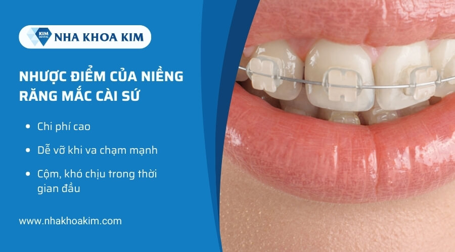 Nhược điểm của niềng răng mắc cài sứ