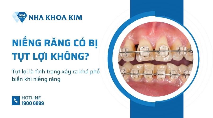 Niềng răng có bị tụt lợi không?