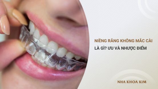 Niềng răng thẩm mỹ không mắc cài là gì? Ưu và nhược điểm