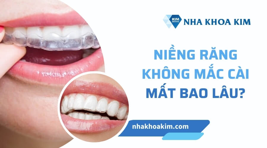 Niềng răng không mắc cài bao lâu?