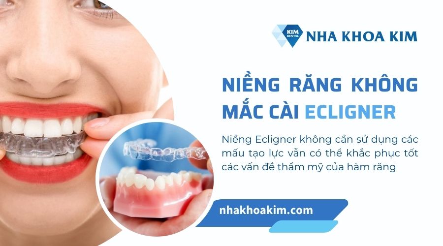 niềng răng không mắc cài Ecligner