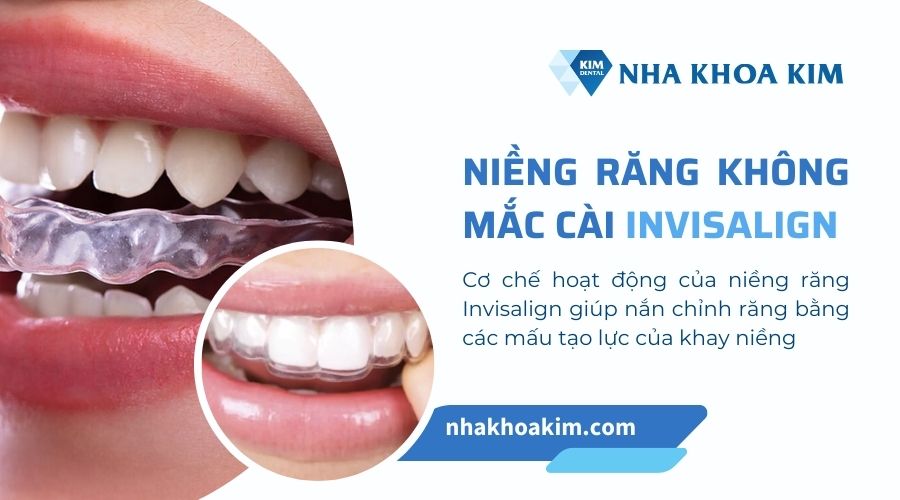 niềng răng trong suốt Invisalign