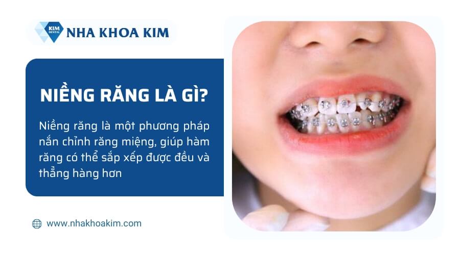 Niềng răng là gì?