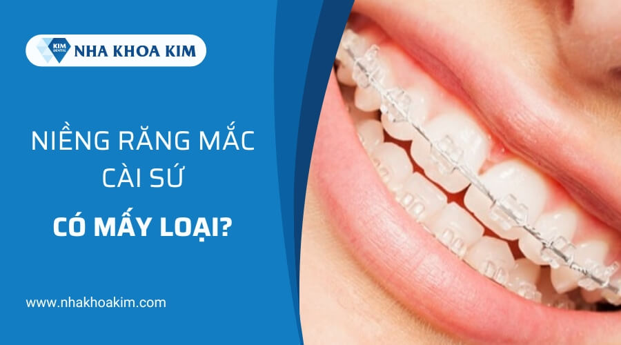 Các loại niềng răng mắc cài sứ 