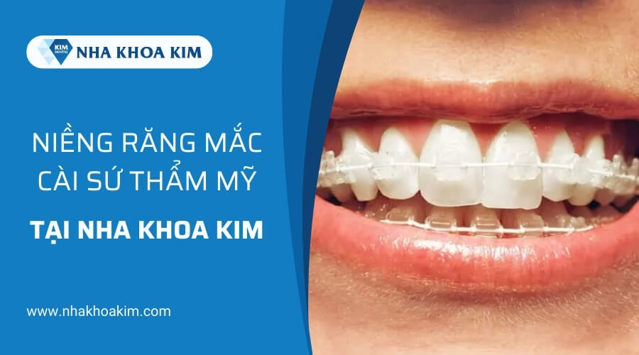 Địa chỉ niềng răng mắc cài sứ an toàn, uy tín