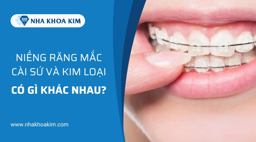 So sánh niềng răng mắc cài sứ và niềng răng kim loại