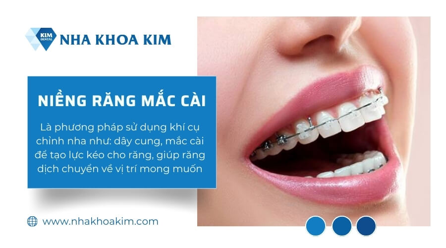 Niềng răng mắc cài cho răng bọc sứ