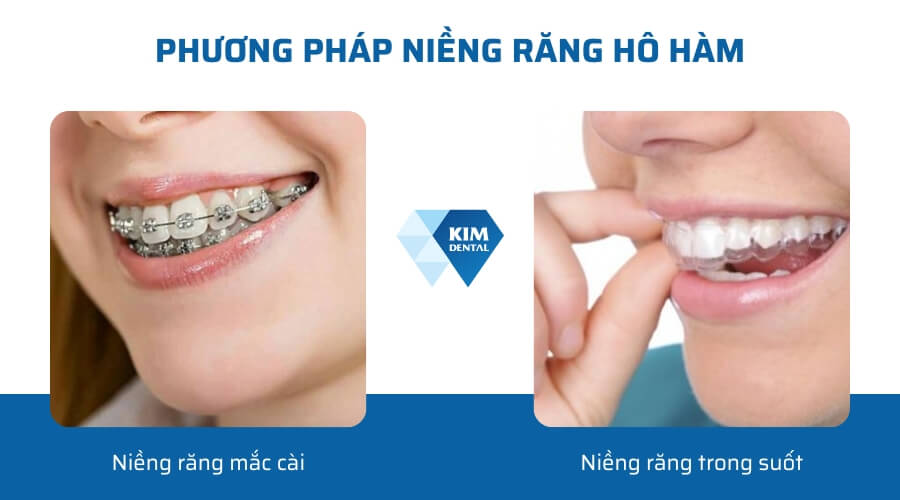 Phương pháp niềng răng hô hàm hiệu quả hiện nay