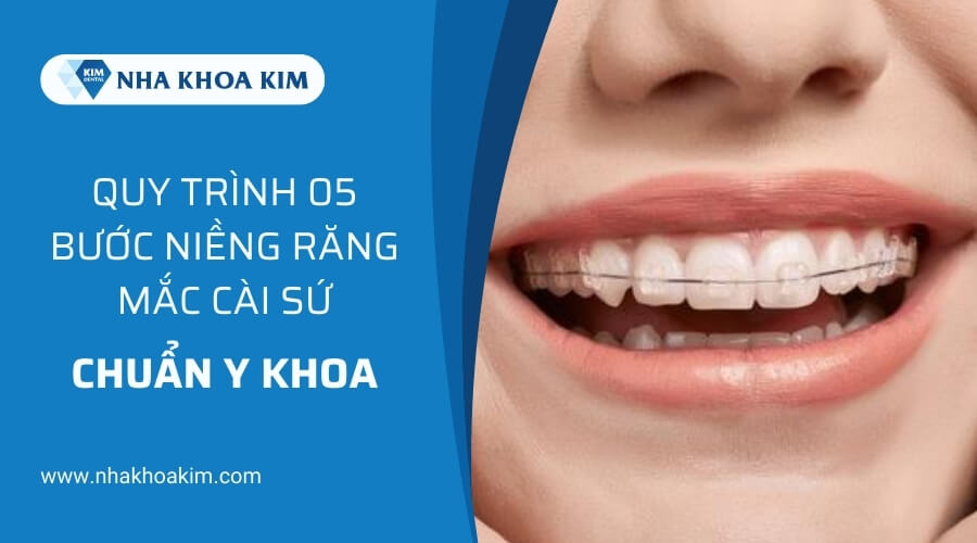 Quy trình niềng răng mắc cài sứ