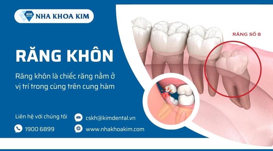 Răng khôn là gì? Có tác dụng gì?