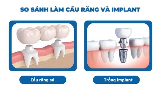 So sánh cầu răng sứ và implant phương pháp nào tốt hơn?