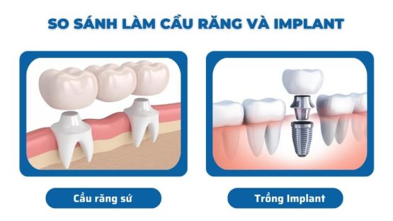 So sánh cầu răng sứ và implant phương pháp nào tốt hơn?
