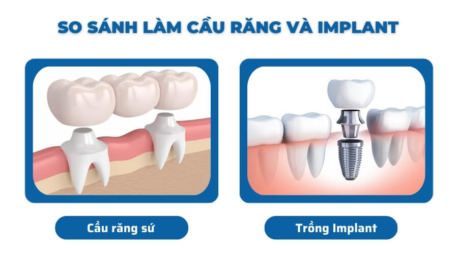 So sánh cầu răng sứ và implant