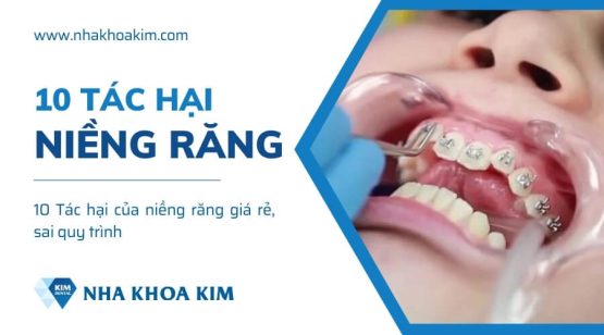 10 Tác hại của niềng răng giá rẻ, sai quy trình