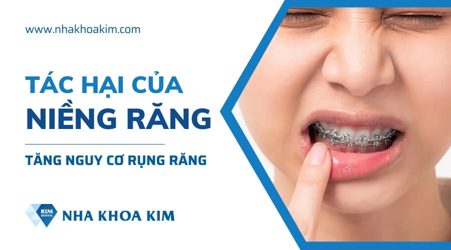 Tác hại của niềng răng sai cách gây mất răng