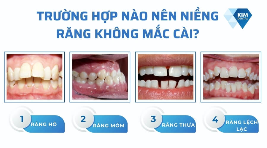 Khi nào nên niềng răng không mắc cài?
