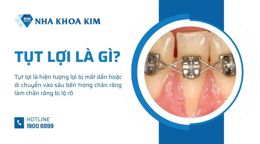 Tụt lợi là gì?