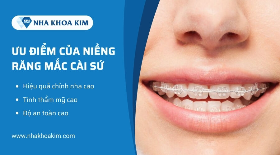 Ưu điểm của niềng răng mắc cài sứ 