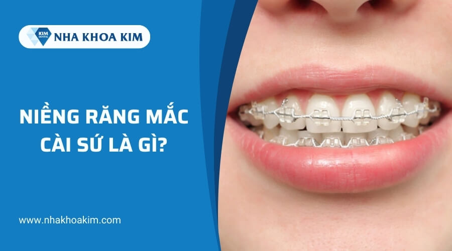 Niềng răng mắc cài sứ là gì?