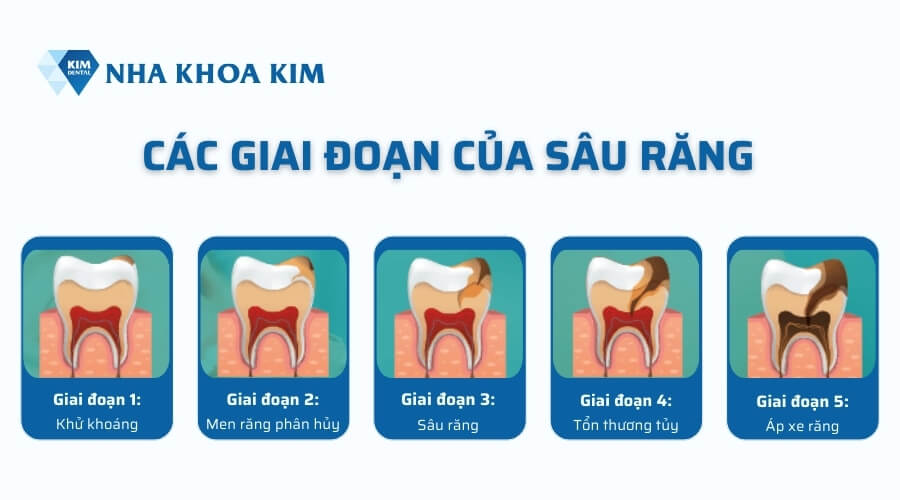 Các giai đoạn của sâu răng