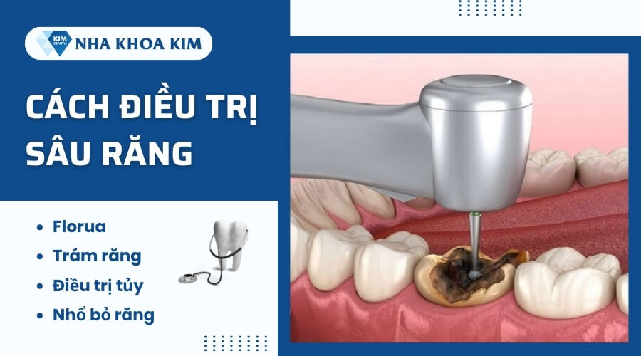 Cách điều trị sâu răng