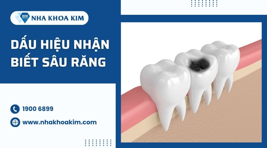 Dấu hiệu nhận biết sâu răng