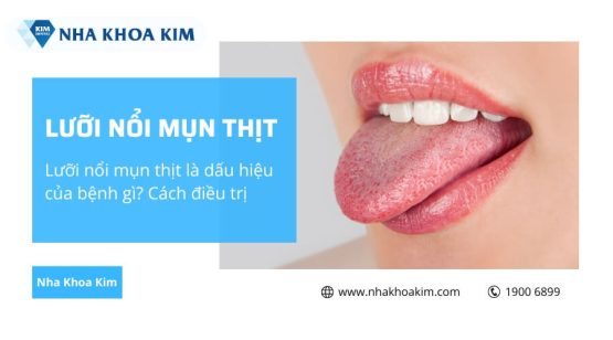 Lưỡi nổi mụn thịt là dấu hiệu của bệnh gì? Cách điều trị