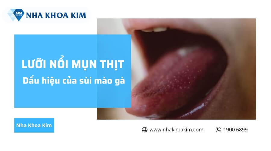 Lưỡi nổi mụn thịt là dấu hiệu của bệnh sùi mào gà 