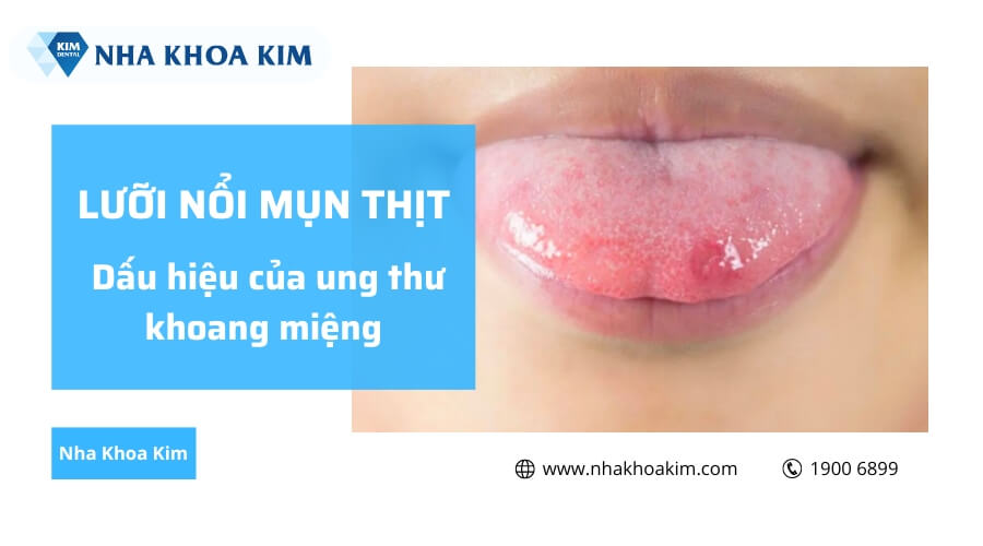 Lưỡi nổi mụn thịt là dấu hiệu của ung thư khoang miệng