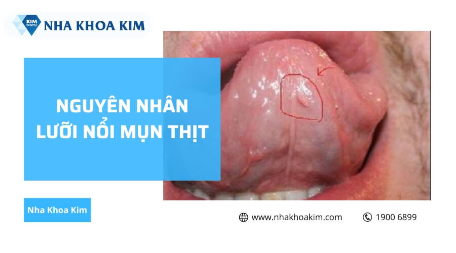 4. Những điều cần lưu ý trong quá trình điều trị