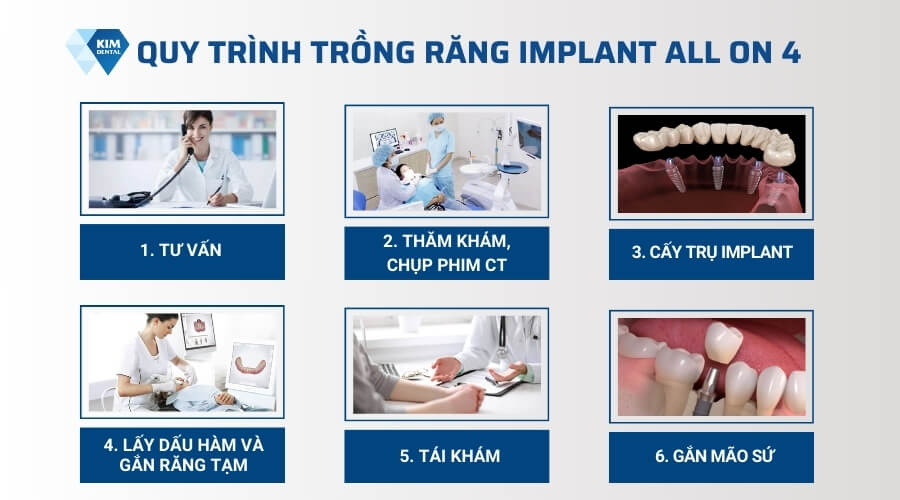 Quy trình cấy ghép implant all on 4 tại Nha Khoa Kim