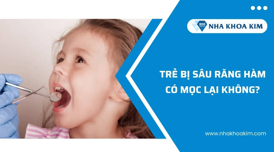 Trẻ bị sâu răng hàm có mọc lại không?