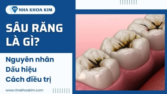 Sâu răng là gì? Nguyên nhân, dấu hiệu và cách điều trị