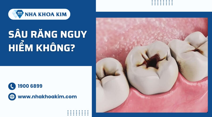 Sâu răng có nguy hiểm không?