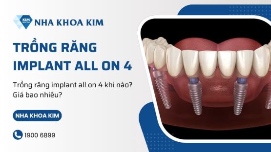 Trồng răng implant all on 4 khi nào? Giá bao nhiêu?