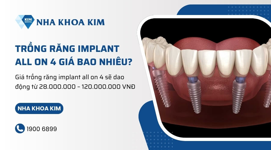 Trồng răng implant all on 4 giá bao nhiêu?