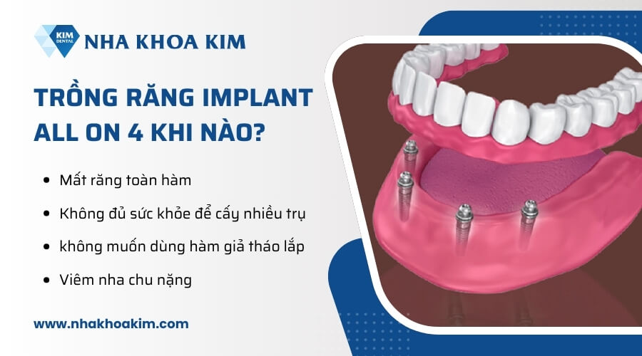 Trồng răng implant all on 4 khi nào?