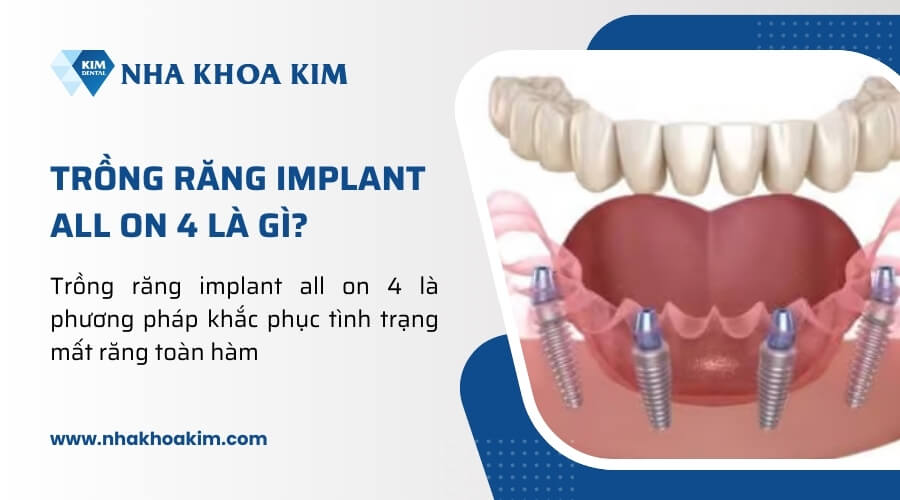 Trồng răng implant all on 4 là gì?