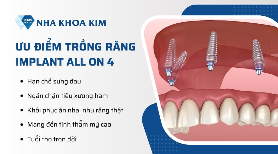 Ưu điểm của trồng răng implant all on 4