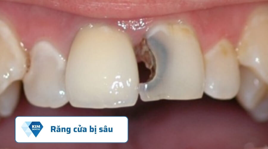 Sâu răng cửa