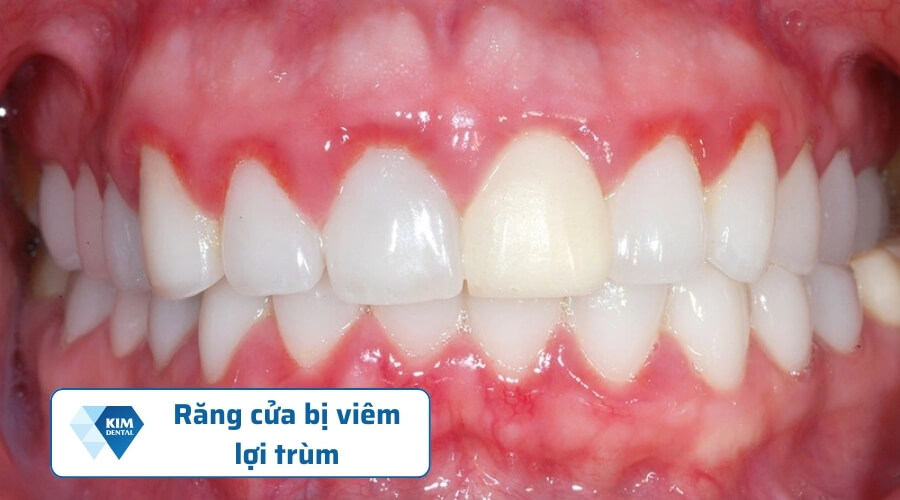 Viêm lợi trùm răng cửa